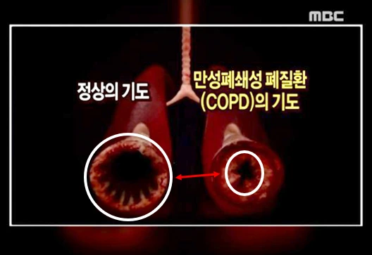 미세먼지 기관지.PNG