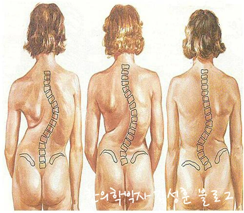 척추측만증증상_과_자가진단4.jpg