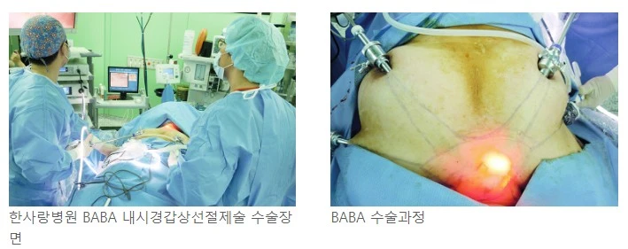 8.한사랑병원 BABA 내시경갑상선절제술 수술장면.JPG