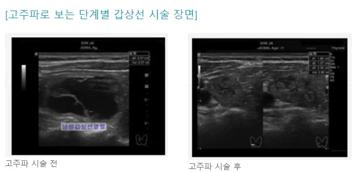 6.고주파로 보는 단계별 갑상선 시술 장면.JPG