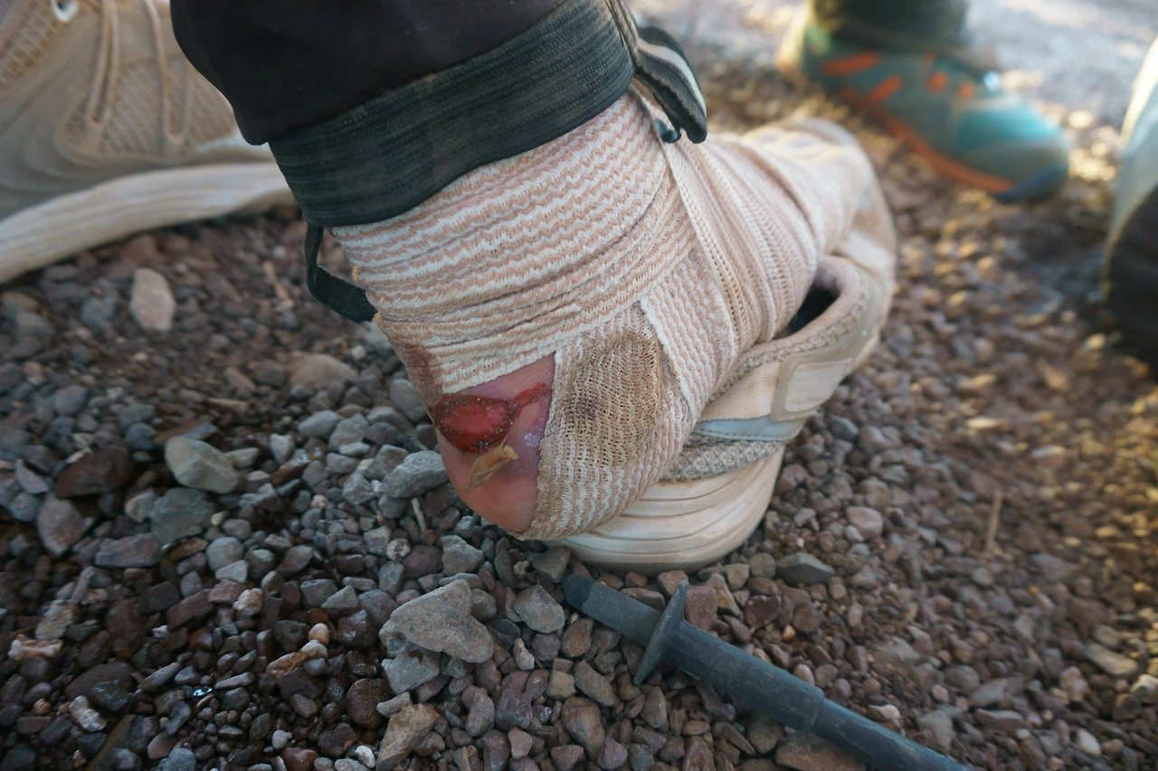 광훈이 뒷꿈치.JPG