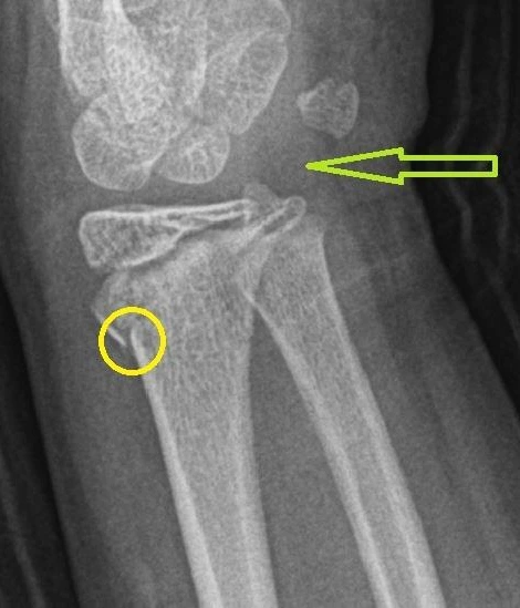 ped radius fracture.JPG