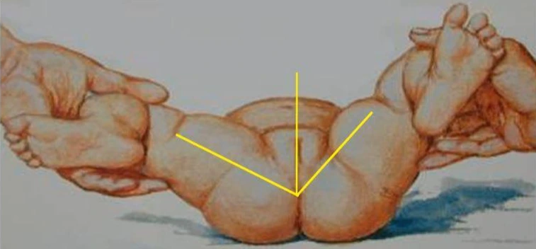 abduction limitation.JPG