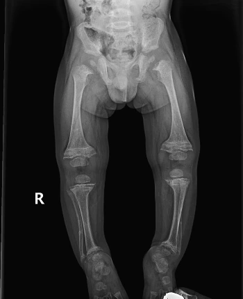 rickets X-ray.jpeg
