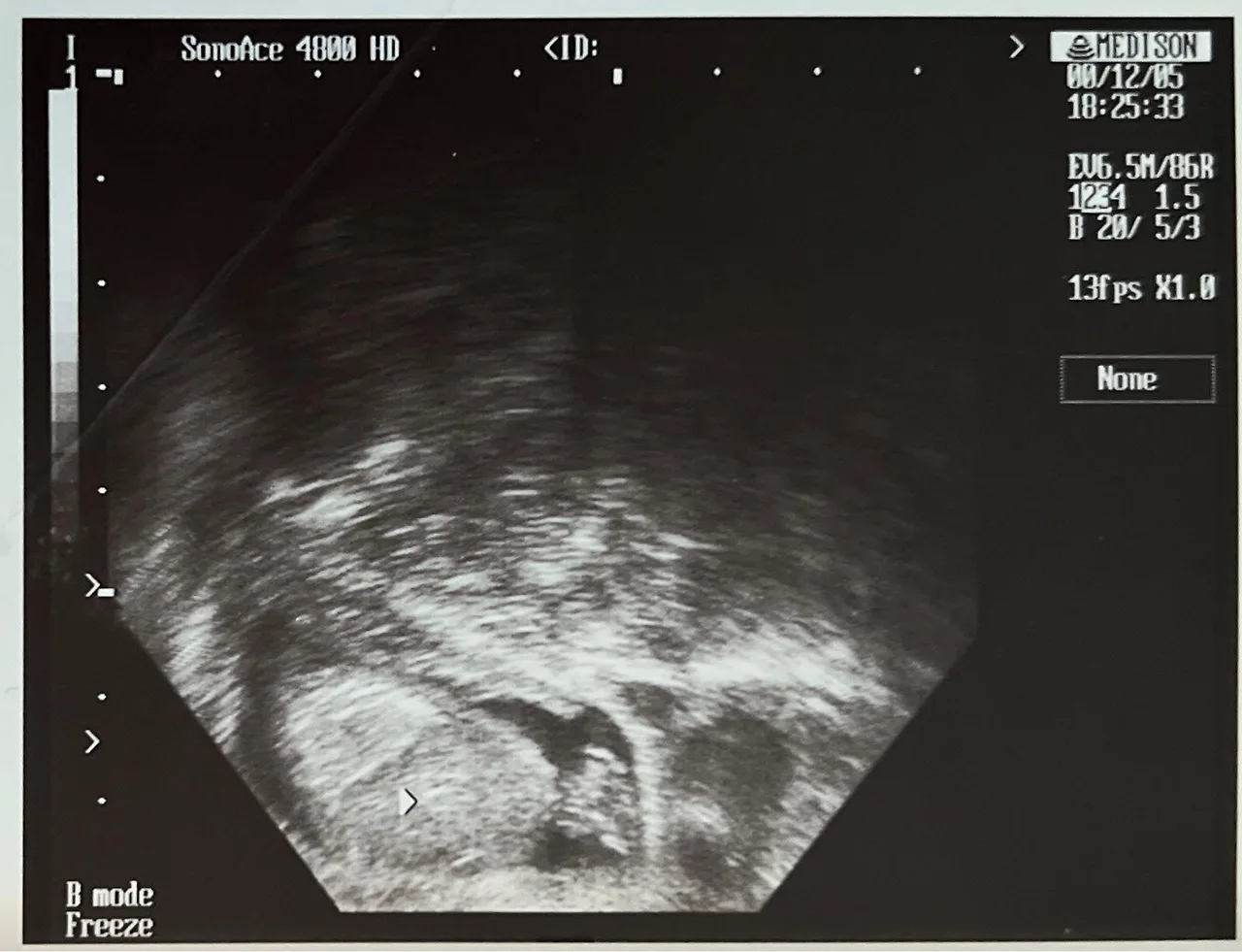 39. 별이 초음파 사진.JPG