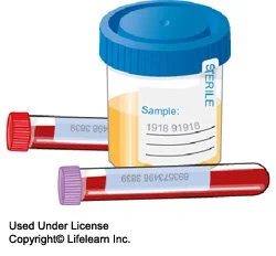 addisons_disease_-_2_-_2009.jpg?la=en&amp;hash=2A35AF8D57AFF7E7F223C82085D3D8C8