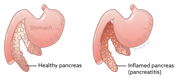 stomachandpancreaspancreatitis201701scaler.jpg?la=en&amp;hash=C6F0E2102035FF921159489735F0B6BA