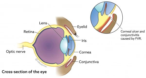 eyebasiccrosssectionulcer201801scaler.jpg?la=en&amp;hash=8F7316BE8CCC24EE8BB33CE7672C539D