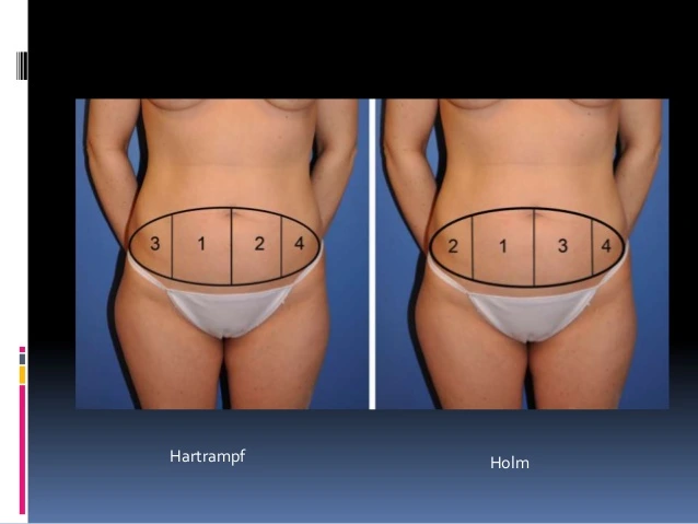 diep-flap-for-breast-reconstruction-12-638.jpg?type=w773