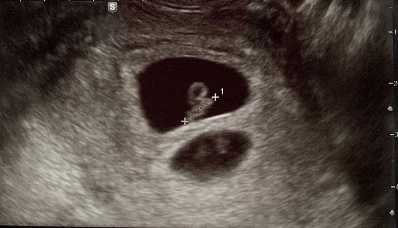 쌍둥이초음파.jpeg