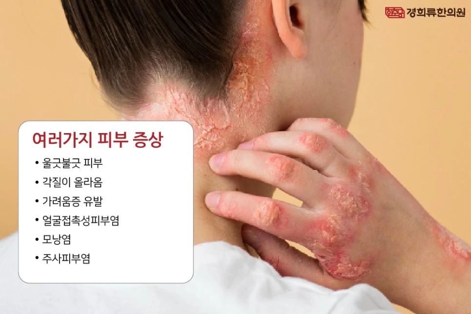 231109_%ED%94%BC%EB%B6%80%ED%95%B4%EB%8F%85%ED%95%9C%EC%95%BD02.jpg?type=w966