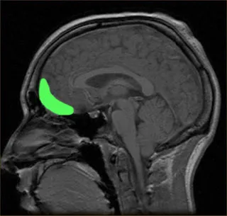 OrbitoFrontalCortex_Optimism_Wikimedia_0.jpg?itok=ej4VGCNG
