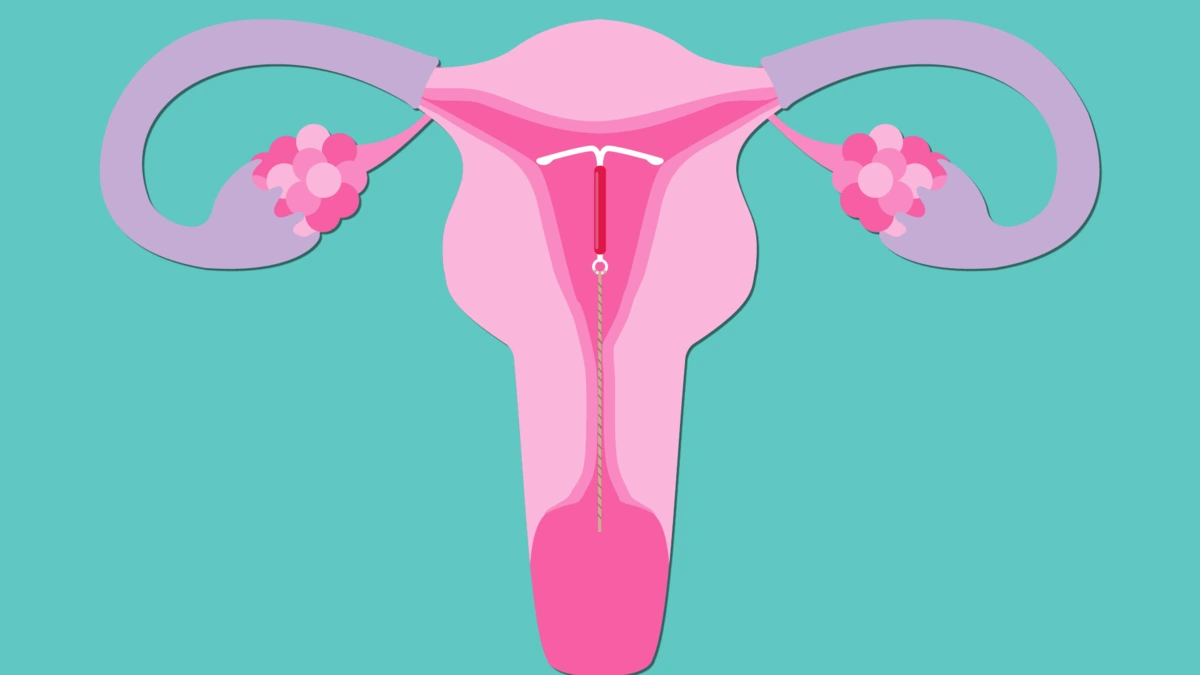 birth-control-iuds.png?type=w1200