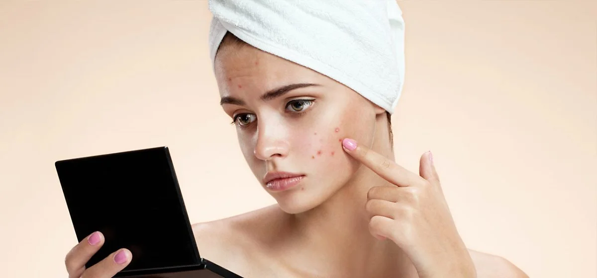 How-To-Get-Rid-Of-Pimples.jpg?type=w1200