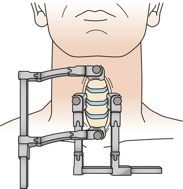 cervica lretractor-Clinical gate.jpeg