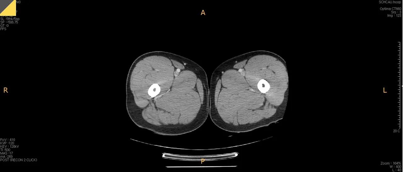 허벅지CT.JPG