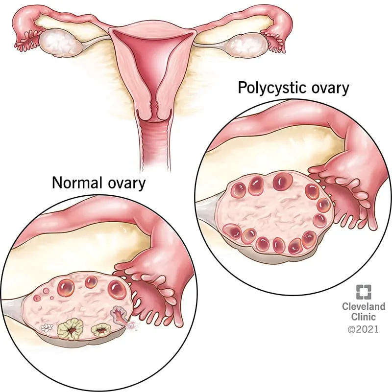 8316-polycystic-ovary-syndrome-pcos