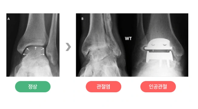 발목관절염.PNG