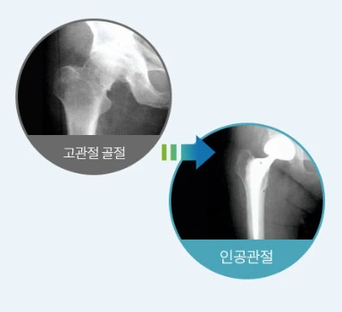 인공관절치환술.PNG