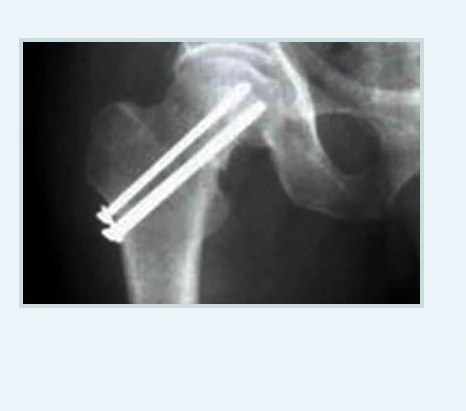 골절유합술.PNG