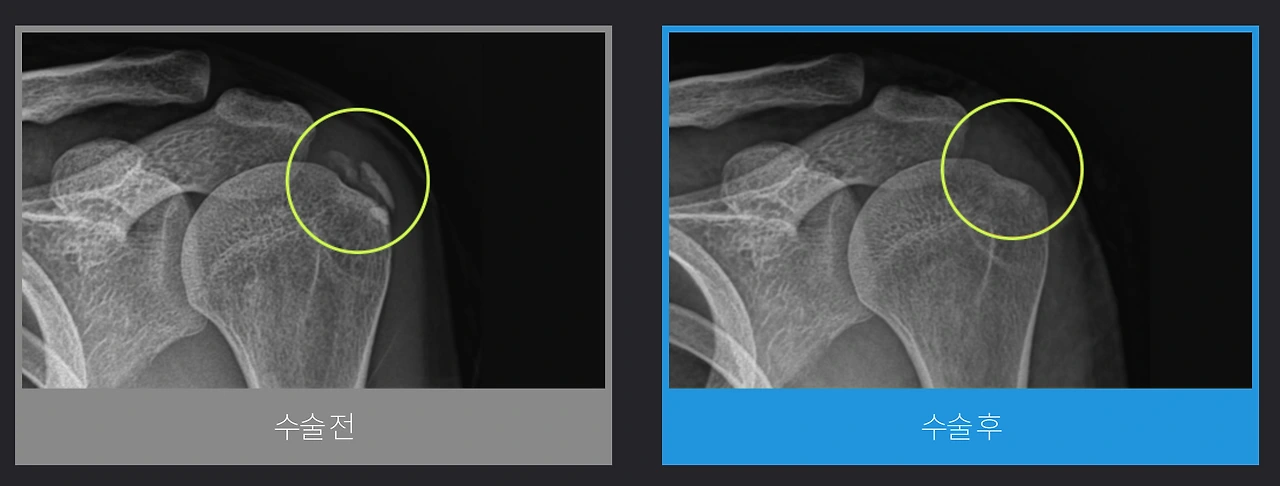 어깨석회관절내시경.PNG