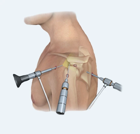 관절내시경.PNG