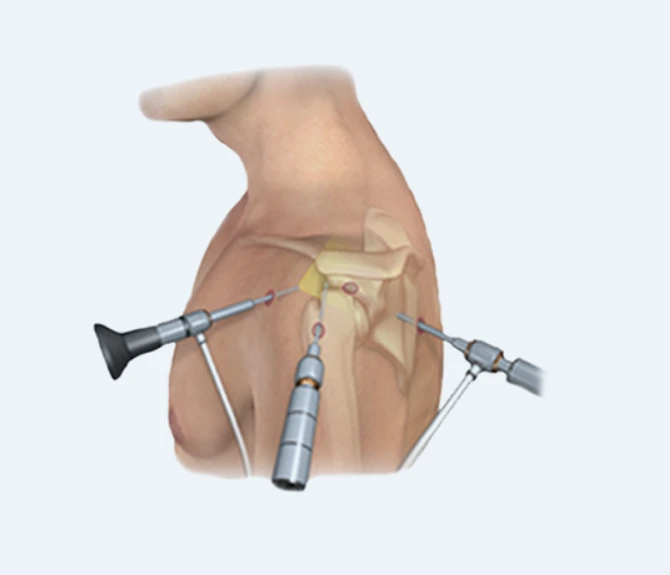 어깨결림 최소절개관절경.PNG