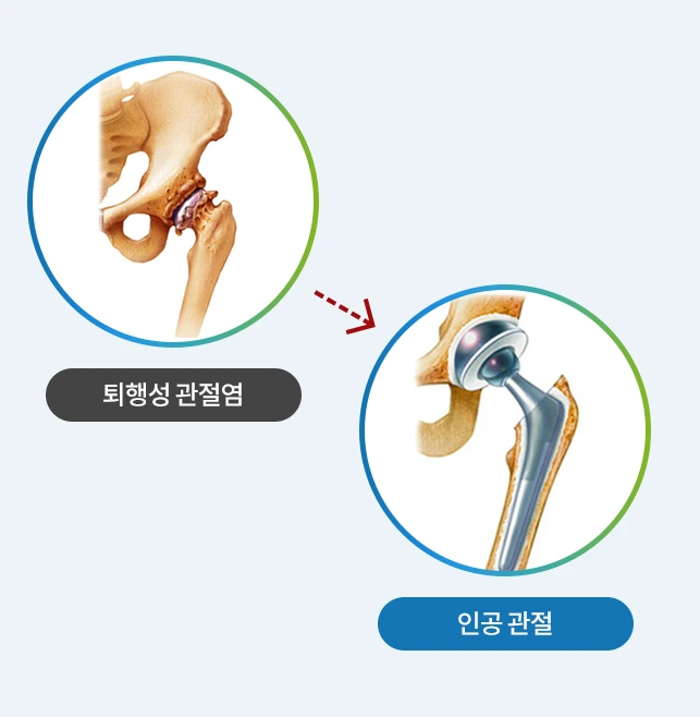 인공고관절치환술.PNG