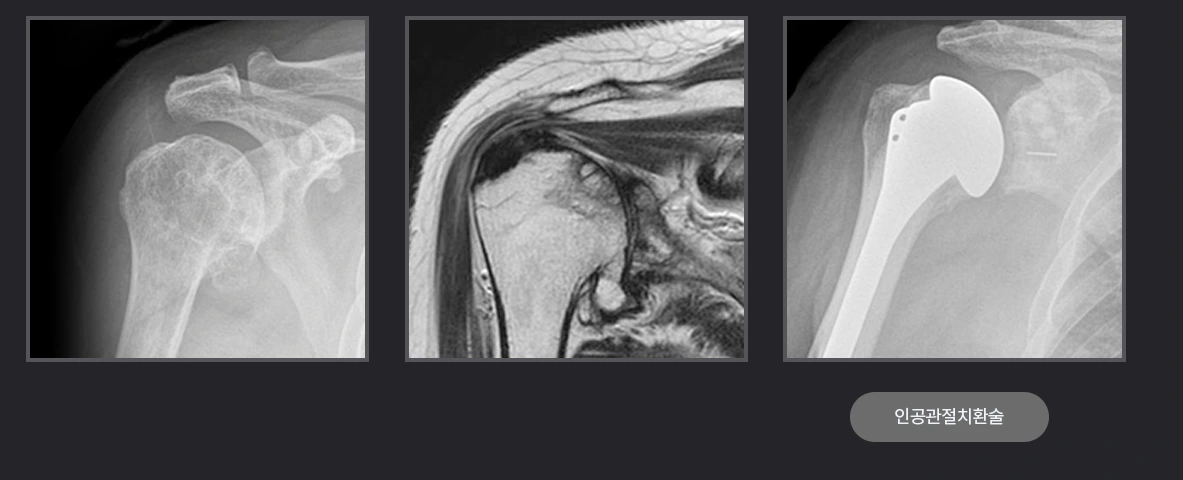 인공관절치환술.PNG