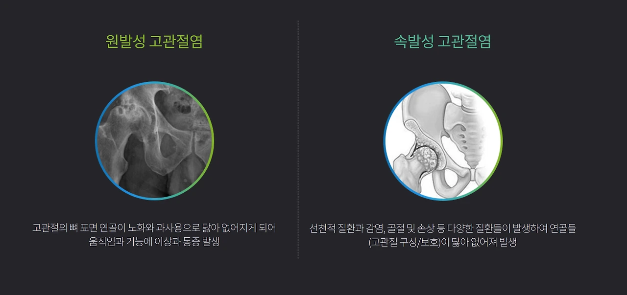 퇴행성관절염.PNG