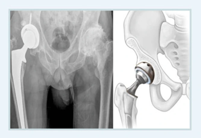 인공관절치환술.PNG