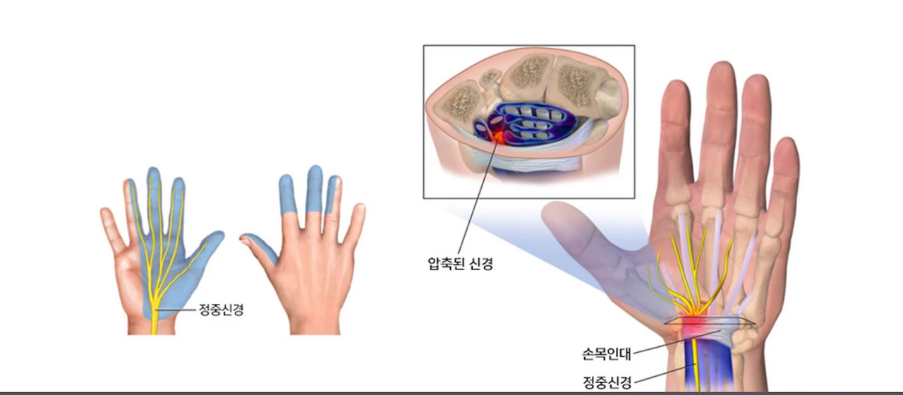 손목터널증후군.PNG