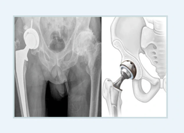 인공관절치환술.PNG