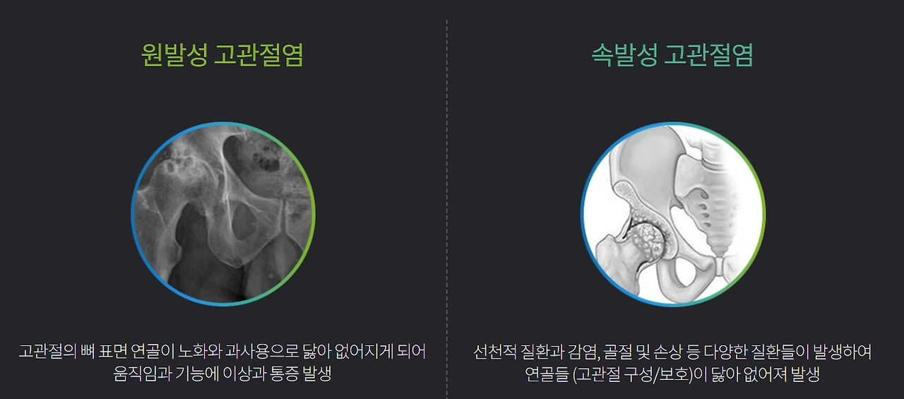 고관절염.PNG