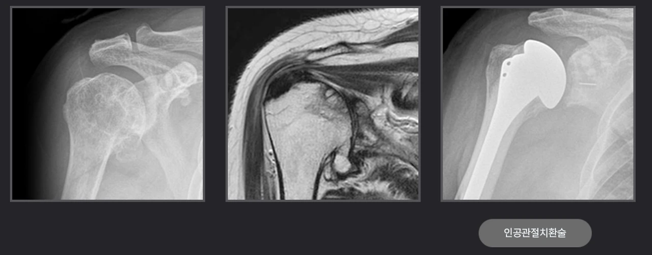 인공관절치환술.PNG