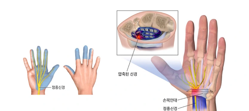 손목터널증후군.PNG