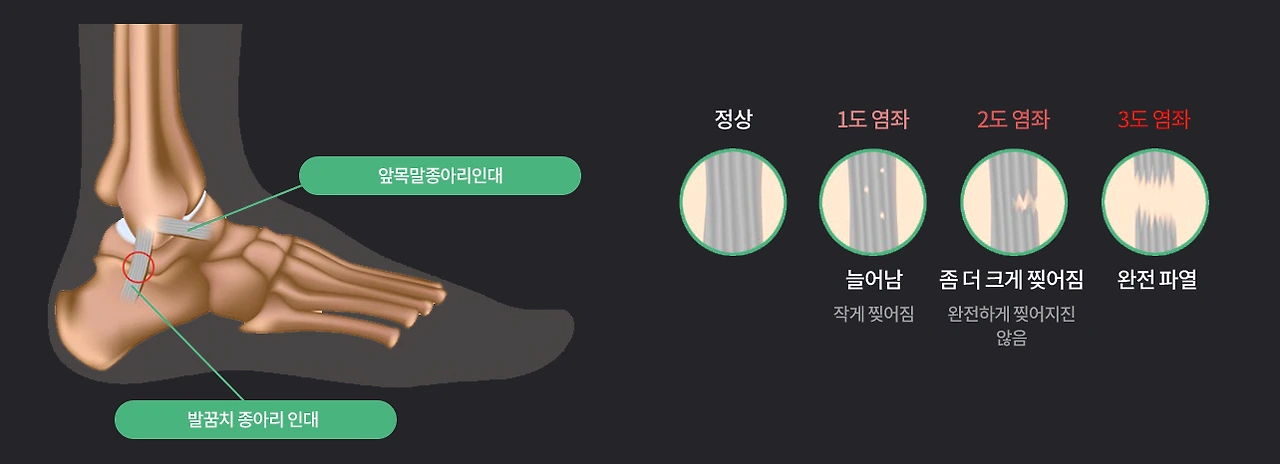 염좌단계.PNG
