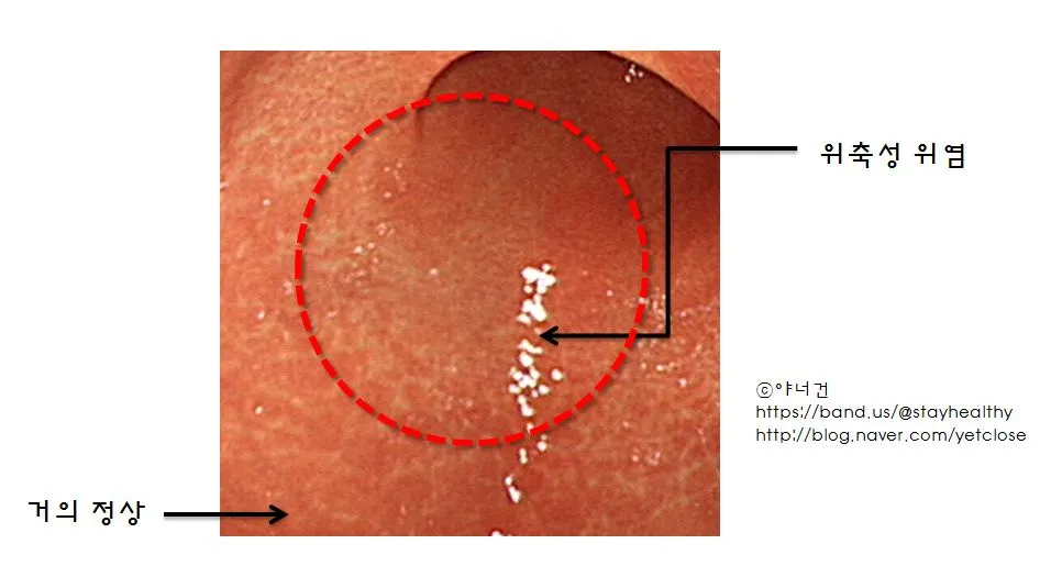 위축성 위염.JPG