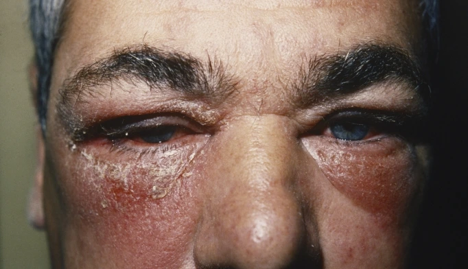 urticariaangioedemaclinical_811668.jpg?type=w1