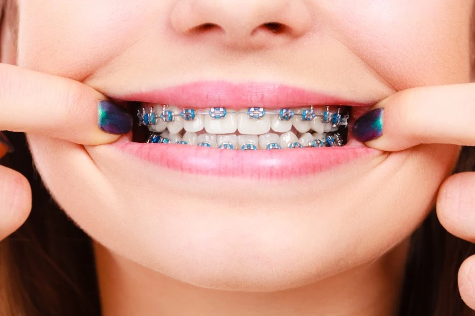 metal-braces-4-scaled.jpg?type=w1