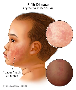 15774-fifth-disease