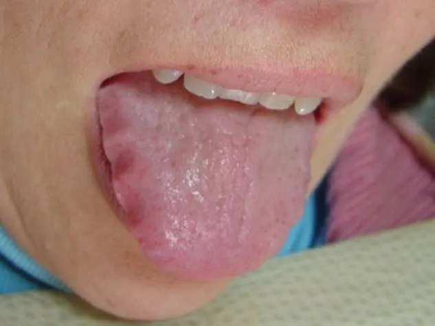 Scalloped-Tongue-Pictures-Causes-Treatment.jpeg
