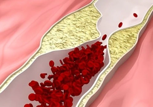 %EA%B3%A0%ED%98%88%EC%95%95.PNG?type=w1