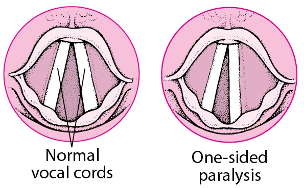 ent_vocal_cord_paralysis.gif?thn=0&sc_lang=en