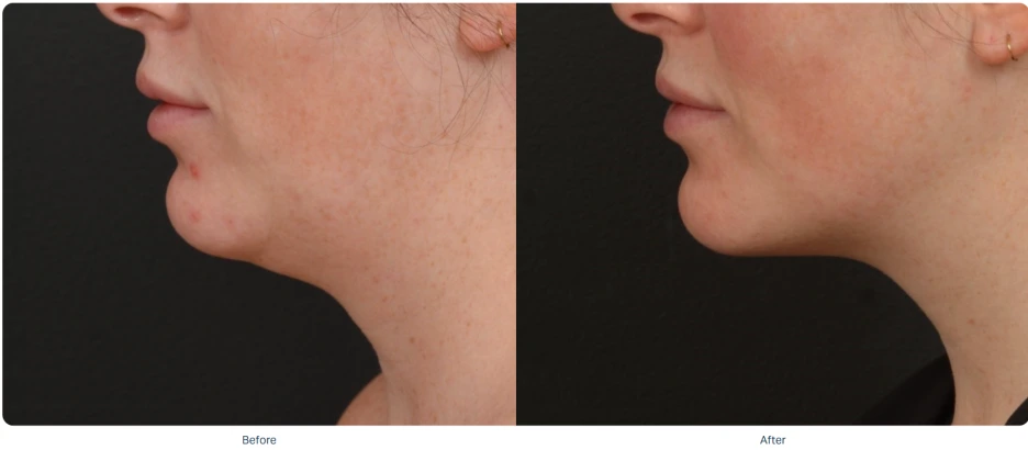 %EC%86%8C%ED%94%84%EC%9B%A8%EC%9D%B4%EB%B8%8C_%EC%A0%84%ED%9B%84_0.png?type=w1