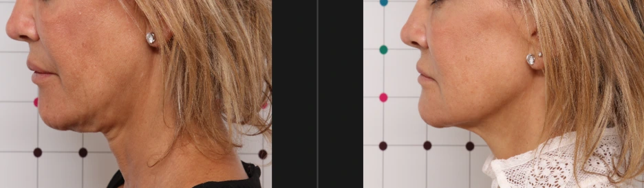 %EC%98%A8%EB%8B%A4_%EC%A0%84%ED%9B%84.png?type=w1