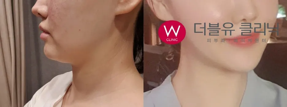 W%ED%81%B4%EB%A6%AC%EB%8B%89_%EC%9D%B8%EB%AA%A8%EB%93%9C_%EC%8B%9C%EC%88%A0%EC%A0%84%ED%9B%84.jpg?type=w1