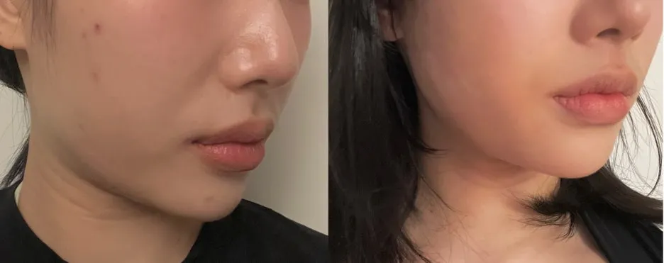 %EB%A6%AC%ED%94%84%ED%8C%85_%EC%8B%9C%EC%88%A0_%EC%A0%84%ED%9B%842.jpeg?type=w1