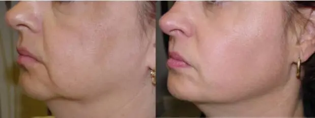 %EC%8D%A8%EB%A7%88%EC%A7%80_%EC%A0%84%ED%9B%84.jpg?type=w1