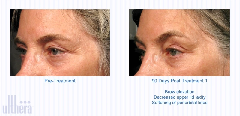 UltheraEyes.jpg?type=w1